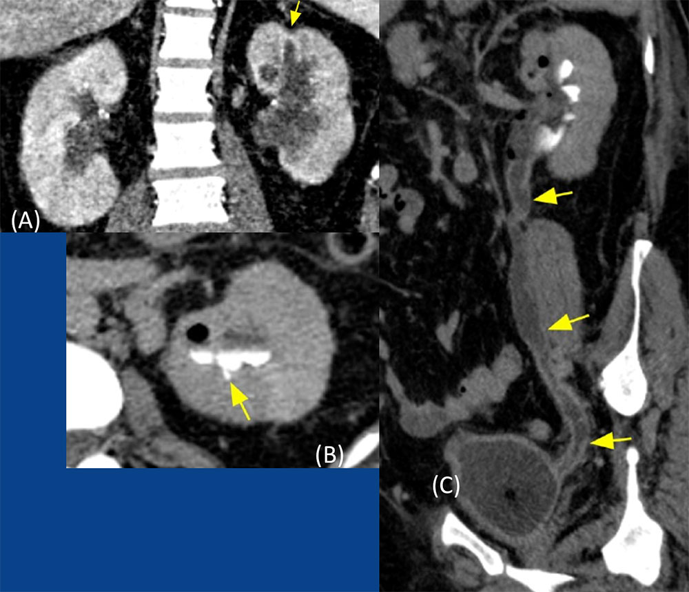 Renal and Urinary Tract Tuberculosis